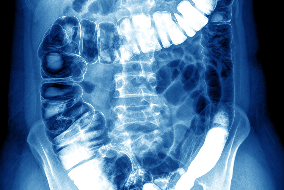 Colon xray gastrointestinal medicine